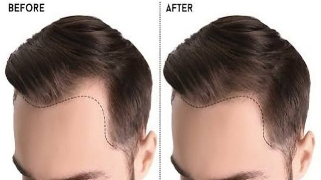 Hairline до и после