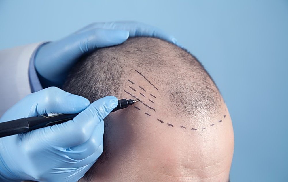 Hairline консультация
